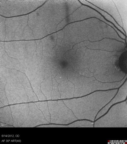 Serous Retinal Detachment - Hypertensive Retinopathy - 165/120 - Fundus Autofluorescence (FAF)
48-year-old woman noticed when she was blinking there was a white flash in the left eye starting about a month ago.  She sees it temporally.  OD 20/16,  OS 20/20.  There is a serous retinal detachment superotemporal to the optic nerve falling short of the fovea.   Her blood pressure 165/120. 
