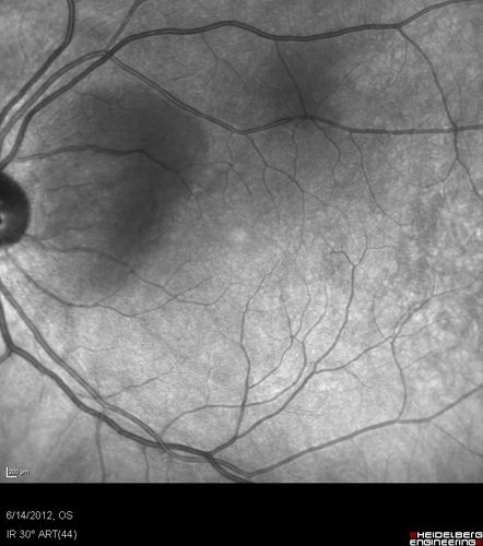 Serous Retinal Detachment - Hypertensive Retinopathy - 165/120 Infra Red
48-year-old woman noticed when she was blinking there was a white flash in the left eye starting about a month ago.  She sees it temporally.  OD 20/16,  OS 20/20.  There is a serous retinal detachment superotemporal to the optic nerve falling short of the fovea.   Her blood pressure 165/120. 
