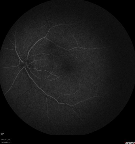 Serous Retinal Detachment - Hypertensive Retinopathy - 165/120 - Fluorescein Angiogram
48-year-old woman noticed when she was blinking there was a white flash in the left eye starting about a month ago.  She sees it temporally.  OD 20/16,  OS 20/20.  There is a serous retinal detachment superotemporal to the optic nerve falling short of the fovea.   Her blood pressure 165/120. 
