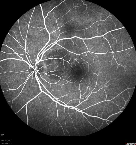 Serous Retinal Detachment - Hypertensive Retinopathy - 165/120 - Fluorescein Angiogram
48-year-old woman noticed when she was blinking there was a white flash in the left eye starting about a month ago.  She sees it temporally.  OD 20/16,  OS 20/20.  There is a serous retinal detachment superotemporal to the optic nerve falling short of the fovea.   Her blood pressure 165/120. 
