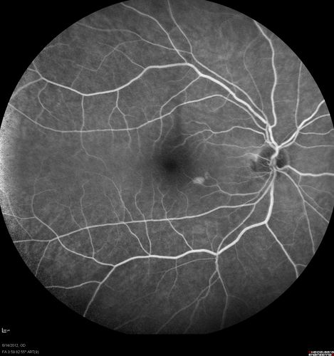 Serous Retinal Detachment - Hypertensive Retinopathy - 165/120 - Fluorescein Angiogram
48-year-old woman noticed when she was blinking there was a white flash in the left eye starting about a month ago.  She sees it temporally.  OD 20/16,  OS 20/20.  There is a serous retinal detachment superotemporal to the optic nerve falling short of the fovea.   Her blood pressure 165/120. 
