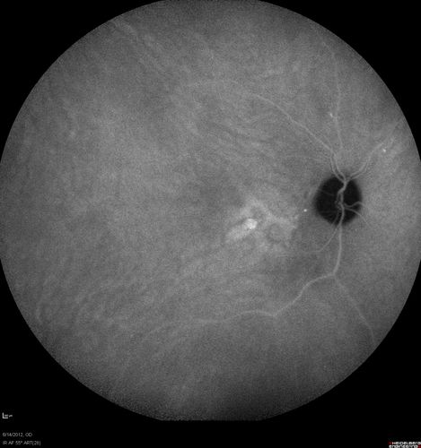 Serous Retinal Detachment - Hypertensive Retinopathy - 165/120 - Late - ICG shows leakage
48-year-old woman noticed when she was blinking there was a white flash in the left eye starting about a month ago.  She sees it temporally.  OD 20/16,  OS 20/20.  There is a serous retinal detachment superotemporal to the optic nerve falling short of the fovea.   Her blood pressure 165/120. 
