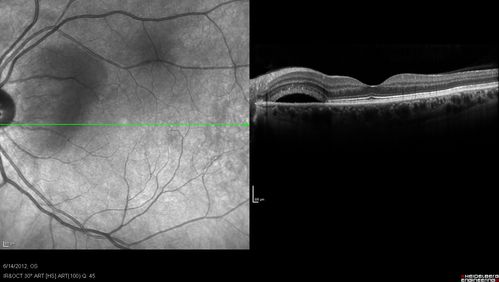 Serous Retinal Detachment - Hypertensive Retinopathy -- 1 month later - less fluid (better blood pressure) SD OCT
48 Year old woman resolving hypertensive serous retinal detachment.
