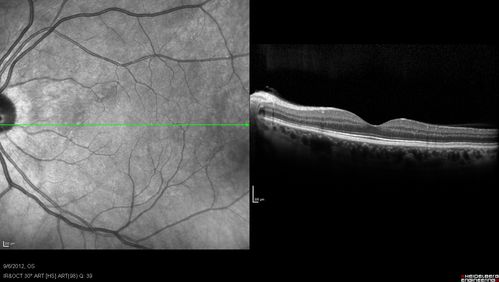 Serous Retinal Detachment - Hypertensive Retinopathy - 3 months later - Fluid has absorbed
48 Year old woman resolved hypertensive serous retinal detachment.
