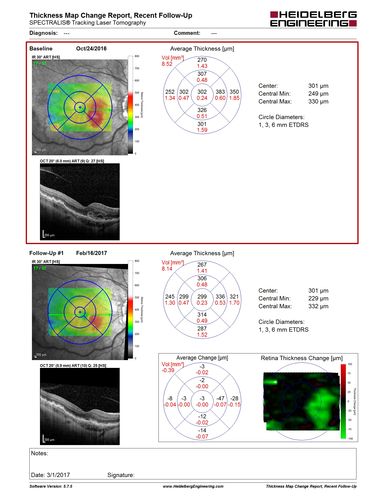 Late Onset Retinal Degeneration (L-ORD)
55 year old with acute vision loss from a CNVM in the right eye.  He responded to Lucentis therapy.  His mother and her family has been confirmed genetically to have L-ORD and were part of the early reports.
