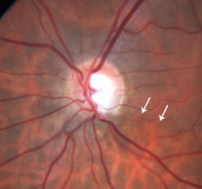 Low Tension Glaucoma - Arrows show nerve fiber layer defect
59-year-old woman has a history of glaucoma dating back to 1990.  She had trabeculectomy in the left eye in 1998 and then persisted to lose vision despite normal intraocular pressures from low-tension glaucoma in the left eye.  She is now on Cosopt and Travatan in both eyes.
Vision OD is 20/20, OS is 20/16.  IOP:  OD 9, OS 6.  


Keywords: optic atrophy; nerve fiber layer defect; glaucoma; low tension glaucoma