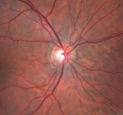Low Tension Glaucoma
59-year-old woman has a history of glaucoma dating back to 1990.  She had trabeculectomy in the left eye in 1998 and then persisted to lose vision despite normal intraocular pressures from low-tension glaucoma in the left eye.  She is now on Cosopt and Travatan in both eyes.
Vision OD is 20/20, OS is 20/16.  IOP:  OD 9, OS 6.  


Keywords: optic atrophy; nerve fiber layer defect; glaucoma; low tension glaucoma