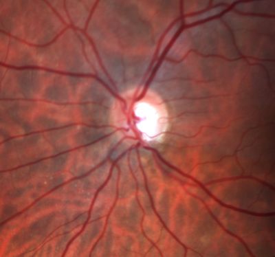 Low Tension Glaucoma
59-year-old woman has a history of glaucoma dating back to 1990.  She had trabeculectomy in the left eye in 1998 and then persisted to lose vision despite normal intraocular pressures from low-tension glaucoma in the left eye.  She is now on Cosopt and Travatan in both eyes.
Vision OD is 20/20, OS is 20/16.  IOP:  OD 9, OS 6.  


Keywords: optic atrophy; nerve fiber layer defect; glaucoma; low tension glaucoma
