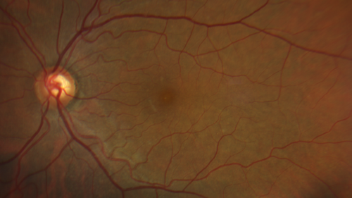 Ocular Lymphoma - Initially presented like auto-immune retinopathy
43 year old man: initial presentation - The vision in the left eye is blurry and opaque for about 2 weeks.Â  In the central of the vision, when he covers the right eye, in the center of the left eye there is a film with a light in the middle.Â  This has never happened before.Â  He has not been sick for the last few months.Â  A few weeks ago he saw waves on the floor when looking down but that has gone away.Â  Since the vision loss started the vision has not changed much.Â  The central vision is not getting better.Â Â 
PMHx â€“ Borderline HTN
VA OD: Dcc20/20
VA OS: Dcc20/40-1 IOP: TP: OD:15 OS:19
1+ NS 
No uveitis
Labs normal.  One positive antiretinal antibody - Arrestin
VA improved over 2 months to normal.  Then the patient had 2 more episodes of self-limited vision loss (no treatment).  Then 2 years later he presented with a diagnosis of CNS lymphoma and later developed subretinal deposits (last images)

