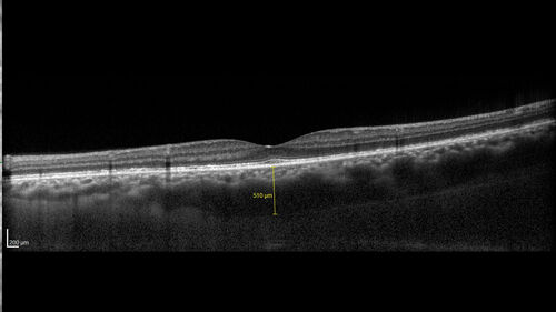 Ocular Lymphoma - Initially presented like auto-immune retinopathy
43 year old man: initial presentation - The vision in the left eye is blurry and opaque for about 2 weeks.Â  In the central of the vision, when he covers the right eye, in the center of the left eye there is a film with a light in the middle.Â  This has never happened before.Â  He has not been sick for the last few months.Â  A few weeks ago he saw waves on the floor when looking down but that has gone away.Â  Since the vision loss started the vision has not changed much.Â  The central vision is not getting better.Â Â 
PMHx â€“ Borderline HTN
VA OD: Dcc20/20
VA OS: Dcc20/40-1 IOP: TP: OD:15 OS:19
1+ NS 
No uveitis
Labs normal.  One positive antiretinal antibody - Arrestin
VA improved over 2 months to normal.  Then the patient had 2 more episodes of self-limited vision loss (no treatment).  Then 2 years later he presented with a diagnosis of CNS lymphoma and later developed subretinal deposits (last images)
