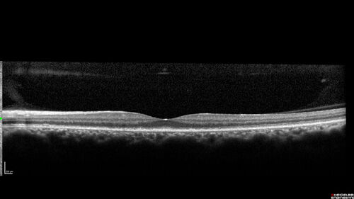 Ocular Lymphoma - Initially presented like auto-immune retinopathy
43 year old man: initial presentation - The vision in the left eye is blurry and opaque for about 2 weeks.Â  In the central of the vision, when he covers the right eye, in the center of the left eye there is a film with a light in the middle.Â  This has never happened before.Â  He has not been sick for the last few months.Â  A few weeks ago he saw waves on the floor when looking down but that has gone away.Â  Since the vision loss started the vision has not changed much.Â  The central vision is not getting better.Â Â 
PMHx â€“ Borderline HTN
VA OD: Dcc20/20
VA OS: Dcc20/40-1 IOP: TP: OD:15 OS:19
1+ NS 
No uveitis
Labs normal.  One positive antiretinal antibody - Arrestin
VA improved over 2 months to normal.  Then the patient had 2 more episodes of self-limited vision loss (no treatment).  Then 2 years later he presented with a diagnosis of CNS lymphoma and later developed subretinal deposits (last images)
