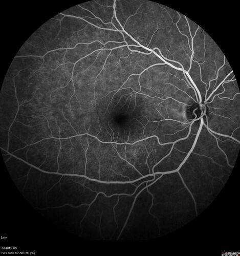 Ocular Lymphoma - Initially presented like auto-immune retinopathy
43 year old man: initial presentation - The vision in the left eye is blurry and opaque for about 2 weeks.Â  In the central of the vision, when he covers the right eye, in the center of the left eye there is a film with a light in the middle.Â  This has never happened before.Â  He has not been sick for the last few months.Â  A few weeks ago he saw waves on the floor when looking down but that has gone away.Â  Since the vision loss started the vision has not changed much.Â  The central vision is not getting better.Â Â 
PMHx â€“ Borderline HTN
VA OD: Dcc20/20
VA OS: Dcc20/40-1 IOP: TP: OD:15 OS:19
1+ NS 
No uveitis
Labs normal.  One positive antiretinal antibody - Arrestin
VA improved over 2 months to normal.  Then the patient had 2 more episodes of self-limited vision loss (no treatment).  Then 2 years later he presented with a diagnosis of CNS lymphoma and later developed subretinal deposits (last images)
