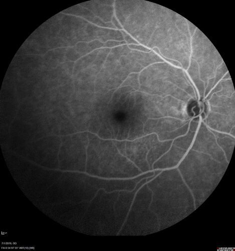 Ocular Lymphoma - Initially presented like auto-immune retinopathy
43 year old man: initial presentation - The vision in the left eye is blurry and opaque for about 2 weeks.Â  In the central of the vision, when he covers the right eye, in the center of the left eye there is a film with a light in the middle.Â  This has never happened before.Â  He has not been sick for the last few months.Â  A few weeks ago he saw waves on the floor when looking down but that has gone away.Â  Since the vision loss started the vision has not changed much.Â  The central vision is not getting better.Â Â 
PMHx â€“ Borderline HTN
VA OD: Dcc20/20
VA OS: Dcc20/40-1 IOP: TP: OD:15 OS:19
1+ NS 
No uveitis
Labs normal.  One positive antiretinal antibody - Arrestin
VA improved over 2 months to normal.  Then the patient had 2 more episodes of self-limited vision loss (no treatment).  Then 2 years later he presented with a diagnosis of CNS lymphoma and later developed subretinal deposits (last images)
