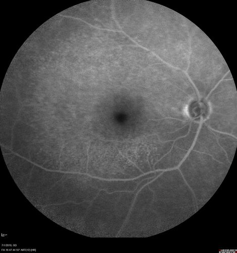 Ocular Lymphoma - Initially presented like auto-immune retinopathy
43 year old man: initial presentation - The vision in the left eye is blurry and opaque for about 2 weeks.Â  In the central of the vision, when he covers the right eye, in the center of the left eye there is a film with a light in the middle.Â  This has never happened before.Â  He has not been sick for the last few months.Â  A few weeks ago he saw waves on the floor when looking down but that has gone away.Â  Since the vision loss started the vision has not changed much.Â  The central vision is not getting better.Â Â 
PMHx â€“ Borderline HTN
VA OD: Dcc20/20
VA OS: Dcc20/40-1 IOP: TP: OD:15 OS:19
1+ NS 
No uveitis
Labs normal.  One positive antiretinal antibody - Arrestin
VA improved over 2 months to normal.  Then the patient had 2 more episodes of self-limited vision loss (no treatment).  Then 2 years later he presented with a diagnosis of CNS lymphoma and later developed subretinal deposits (last images)
