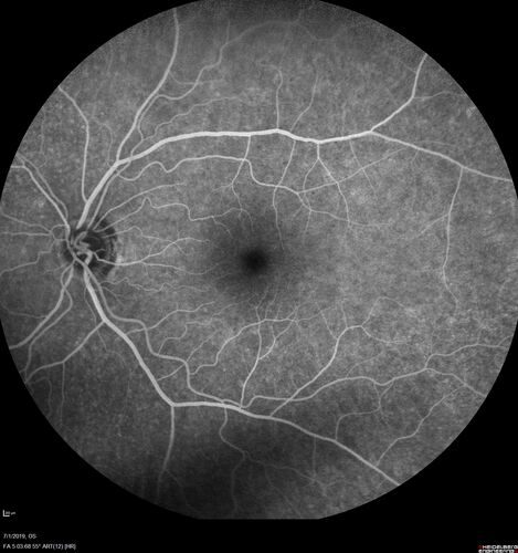 Ocular Lymphoma - Initially presented like auto-immune retinopathy
43 year old man: initial presentation - The vision in the left eye is blurry and opaque for about 2 weeks.Â  In the central of the vision, when he covers the right eye, in the center of the left eye there is a film with a light in the middle.Â  This has never happened before.Â  He has not been sick for the last few months.Â  A few weeks ago he saw waves on the floor when looking down but that has gone away.Â  Since the vision loss started the vision has not changed much.Â  The central vision is not getting better.Â Â 
PMHx â€“ Borderline HTN
VA OD: Dcc20/20
VA OS: Dcc20/40-1 IOP: TP: OD:15 OS:19
1+ NS 
No uveitis
Labs normal.  One positive antiretinal antibody - Arrestin
VA improved over 2 months to normal.  Then the patient had 2 more episodes of self-limited vision loss (no treatment).  Then 2 years later he presented with a diagnosis of CNS lymphoma and later developed subretinal deposits (last images)
