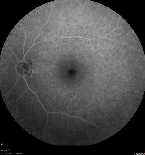 Ocular Lymphoma - Initially presented like auto-immune retinopathy
43 year old man: initial presentation - The vision in the left eye is blurry and opaque for about 2 weeks.Â  In the central of the vision, when he covers the right eye, in the center of the left eye there is a film with a light in the middle.Â  This has never happened before.Â  He has not been sick for the last few months.Â  A few weeks ago he saw waves on the floor when looking down but that has gone away.Â  Since the vision loss started the vision has not changed much.Â  The central vision is not getting better.Â Â 
PMHx â€“ Borderline HTN
VA OD: Dcc20/20
VA OS: Dcc20/40-1 IOP: TP: OD:15 OS:19
1+ NS 
No uveitis
Labs normal.  One positive antiretinal antibody - Arrestin
VA improved over 2 months to normal.  Then the patient had 2 more episodes of self-limited vision loss (no treatment).  Then 2 years later he presented with a diagnosis of CNS lymphoma and later developed subretinal deposits (last images)
