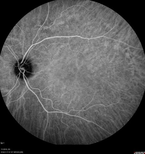 Ocular Lymphoma - Initially presented like auto-immune retinopathy
43 year old man: initial presentation - The vision in the left eye is blurry and opaque for about 2 weeks.Â  In the central of the vision, when he covers the right eye, in the center of the left eye there is a film with a light in the middle.Â  This has never happened before.Â  He has not been sick for the last few months.Â  A few weeks ago he saw waves on the floor when looking down but that has gone away.Â  Since the vision loss started the vision has not changed much.Â  The central vision is not getting better.Â Â 
PMHx â€“ Borderline HTN
VA OD: Dcc20/20
VA OS: Dcc20/40-1 IOP: TP: OD:15 OS:19
1+ NS 
No uveitis
Labs normal.  One positive antiretinal antibody - Arrestin
VA improved over 2 months to normal.  Then the patient had 2 more episodes of self-limited vision loss (no treatment).  Then 2 years later he presented with a diagnosis of CNS lymphoma and later developed subretinal deposits (last images)
