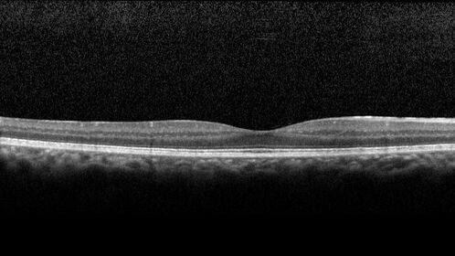 Ocular Lymphoma - Initially presented like auto-immune retinopathy
43 year old man: initial presentation - The vision in the left eye is blurry and opaque for about 2 weeks.Â  In the central of the vision, when he covers the right eye, in the center of the left eye there is a film with a light in the middle.Â  This has never happened before.Â  He has not been sick for the last few months.Â  A few weeks ago he saw waves on the floor when looking down but that has gone away.Â  Since the vision loss started the vision has not changed much.Â  The central vision is not getting better.Â Â 
PMHx â€“ Borderline HTN
VA OD: Dcc20/20
VA OS: Dcc20/40-1 IOP: TP: OD:15 OS:19
1+ NS 
No uveitis
Labs normal.  One positive antiretinal antibody - Arrestin
VA improved over 2 months to normal.  Then the patient had 2 more episodes of self-limited vision loss (no treatment).  Then 2 years later he presented with a diagnosis of CNS lymphoma and later developed subretinal deposits (last images)
