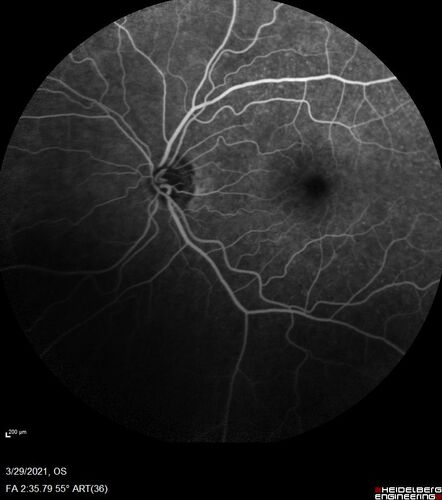 Ocular Lymphoma - Initially presented like auto-immune retinopathy
43 year old man: initial presentation - The vision in the left eye is blurry and opaque for about 2 weeks.Â  In the central of the vision, when he covers the right eye, in the center of the left eye there is a film with a light in the middle.Â  This has never happened before.Â  He has not been sick for the last few months.Â  A few weeks ago he saw waves on the floor when looking down but that has gone away.Â  Since the vision loss started the vision has not changed much.Â  The central vision is not getting better.Â Â 
PMHx â€“ Borderline HTN
VA OD: Dcc20/20
VA OS: Dcc20/40-1 IOP: TP: OD:15 OS:19
1+ NS 
No uveitis
Labs normal.  One positive antiretinal antibody - Arrestin
VA improved over 2 months to normal.  Then the patient had 2 more episodes of self-limited vision loss (no treatment).  Then 2 years later he presented with a diagnosis of CNS lymphoma and later developed subretinal deposits (last images)

