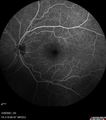 Ocular Lymphoma - Initially presented like auto-immune retinopathy
43 year old man: initial presentation - The vision in the left eye is blurry and opaque for about 2 weeks.Â  In the central of the vision, when he covers the right eye, in the center of the left eye there is a film with a light in the middle.Â  This has never happened before.Â  He has not been sick for the last few months.Â  A few weeks ago he saw waves on the floor when looking down but that has gone away.Â  Since the vision loss started the vision has not changed much.Â  The central vision is not getting better.Â Â 
PMHx â€“ Borderline HTN
VA OD: Dcc20/20
VA OS: Dcc20/40-1 IOP: TP: OD:15 OS:19
1+ NS 
No uveitis
Labs normal.  One positive antiretinal antibody - Arrestin
VA improved over 2 months to normal.  Then the patient had 2 more episodes of self-limited vision loss (no treatment).  Then 2 years later he presented with a diagnosis of CNS lymphoma and later developed subretinal deposits (last images)
