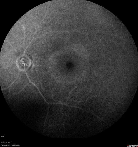 Ocular Lymphoma - Initially presented like auto-immune retinopathy
43 year old man: initial presentation - The vision in the left eye is blurry and opaque for about 2 weeks.Â  In the central of the vision, when he covers the right eye, in the center of the left eye there is a film with a light in the middle.Â  This has never happened before.Â  He has not been sick for the last few months.Â  A few weeks ago he saw waves on the floor when looking down but that has gone away.Â  Since the vision loss started the vision has not changed much.Â  The central vision is not getting better.Â Â 
PMHx â€“ Borderline HTN
VA OD: Dcc20/20
VA OS: Dcc20/40-1 IOP: TP: OD:15 OS:19
1+ NS 
No uveitis
Labs normal.  One positive antiretinal antibody - Arrestin
VA improved over 2 months to normal.  Then the patient had 2 more episodes of self-limited vision loss (no treatment).  Then 2 years later he presented with a diagnosis of CNS lymphoma and later developed subretinal deposits (last images)
