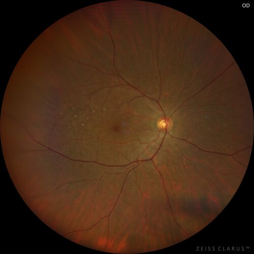 Ocular Lymphoma - Initially presented like auto-immune retinopathy
43 year old man: initial presentation - The vision in the left eye is blurry and opaque for about 2 weeks.Â  In the central of the vision, when he covers the right eye, in the center of the left eye there is a film with a light in the middle.Â  This has never happened before.Â  He has not been sick for the last few months.Â  A few weeks ago he saw waves on the floor when looking down but that has gone away.Â  Since the vision loss started the vision has not changed much.Â  The central vision is not getting better.Â Â 
PMHx â€“ Borderline HTN
VA OD: Dcc20/20
VA OS: Dcc20/40-1 IOP: TP: OD:15 OS:19
1+ NS 
No uveitis
Labs normal.  One positive antiretinal antibody - Arrestin
VA improved over 2 months to normal.  Then the patient had 2 more episodes of self-limited vision loss (no treatment).  Then 2 years later he presented with a diagnosis of CNS lymphoma and later developed subretinal deposits (last images)
