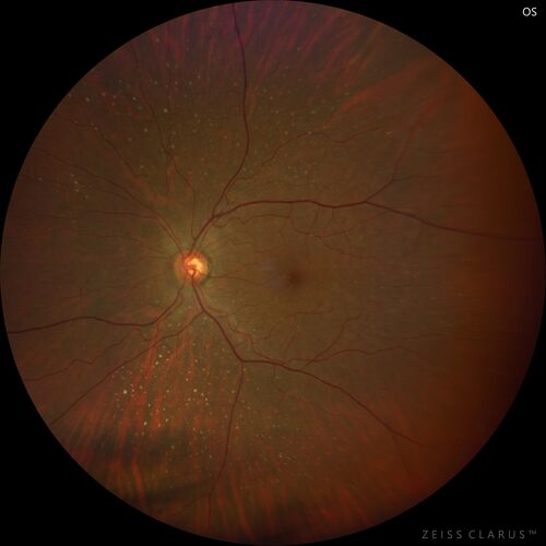 Ocular Lymphoma - Initially presented like auto-immune retinopathy
43 year old man: initial presentation - The vision in the left eye is blurry and opaque for about 2 weeks.Â  In the central of the vision, when he covers the right eye, in the center of the left eye there is a film with a light in the middle.Â  This has never happened before.Â  He has not been sick for the last few months.Â  A few weeks ago he saw waves on the floor when looking down but that has gone away.Â  Since the vision loss started the vision has not changed much.Â  The central vision is not getting better.Â Â 
PMHx â€“ Borderline HTN
VA OD: Dcc20/20
VA OS: Dcc20/40-1 IOP: TP: OD:15 OS:19
1+ NS 
No uveitis
Labs normal.  One positive antiretinal antibody - Arrestin
VA improved over 2 months to normal.  Then the patient had 2 more episodes of self-limited vision loss (no treatment).  Then 2 years later he presented with a diagnosis of CNS lymphoma and later developed subretinal deposits (last images)
