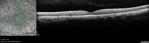 Ocular Lymphoma - Initially presented like auto-immune retinopathy
43 year old man: initial presentation - The vision in the left eye is blurry and opaque for about 2 weeks.Â  In the central of the vision, when he covers the right eye, in the center of the left eye there is a film with a light in the middle.Â  This has never happened before.Â  He has not been sick for the last few months.Â  A few weeks ago he saw waves on the floor when looking down but that has gone away.Â  Since the vision loss started the vision has not changed much.Â  The central vision is not getting better.Â Â 
PMHx â€“ Borderline HTN
VA OD: Dcc20/20
VA OS: Dcc20/40-1 IOP: TP: OD:15 OS:19
1+ NS 
No uveitis
Labs normal.  One positive antiretinal antibody - Arrestin
VA improved over 2 months to normal.  Then the patient had 2 more episodes of self-limited vision loss (no treatment).  Then 2 years later he presented with a diagnosis of CNS lymphoma and later developed subretinal deposits (last images)
