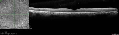Ocular Lymphoma - Initially presented like auto-immune retinopathy
43 year old man: initial presentation - The vision in the left eye is blurry and opaque for about 2 weeks.Â  In the central of the vision, when he covers the right eye, in the center of the left eye there is a film with a light in the middle.Â  This has never happened before.Â  He has not been sick for the last few months.Â  A few weeks ago he saw waves on the floor when looking down but that has gone away.Â  Since the vision loss started the vision has not changed much.Â  The central vision is not getting better.Â Â 
PMHx â€“ Borderline HTN
VA OD: Dcc20/20
VA OS: Dcc20/40-1 IOP: TP: OD:15 OS:19
1+ NS 
No uveitis
Labs normal.  One positive antiretinal antibody - Arrestin
VA improved over 2 months to normal.  Then the patient had 2 more episodes of self-limited vision loss (no treatment).  Then 2 years later he presented with a diagnosis of CNS lymphoma and later developed subretinal deposits (last images)
