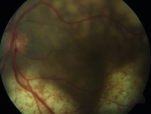 Ocular Lymphoma - non-Hodgkins - B-Cell
Multifocal sub-RPE lesions in the left eye of a patient with history of Non-hodgkins B-cell Lymphoma last active 2 years ago
