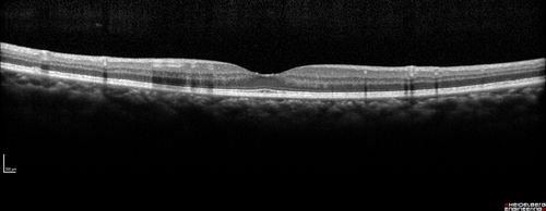 Ocular Lymphoma - non-Hodgkins - B-Cell - Right eye has equatorial drusen
Multifocal sub-RPE lesions in the left eye of a patient with history of Non-hodgkins B-cell Lymphoma last active 2 years ago
