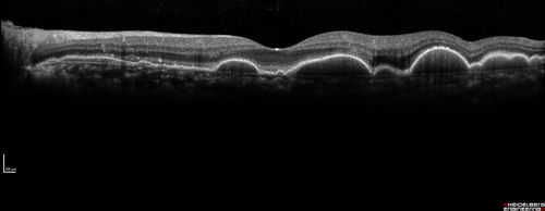 Ocular Lymphoma - non-Hodgkins - B-Cell - OCT shows multifocal sub-RPE masses 
Multifocal sub-RPE lesions in the left eye of a patient with history of Non-hodgkins B-cell Lymphoma last active 2 years ago
