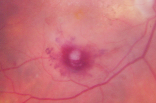 Retinal Arterial Macroaneurysm - Ruptured and self-sealed after hemorrhage
90-year-old woman has vision loss in the right eye for 6 weeks.  OD 8/200,  OS 20/50.  Initial Visit
