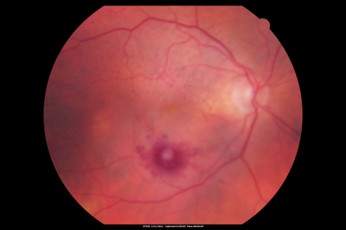 Retinal Arterial Macroaneurysm - Ruptured and self-sealed after hemorrhage
90-year-old woman has vision loss in the right eye for 6 weeks.  OD 8/200,  OS 20/50.  Initial Visit
