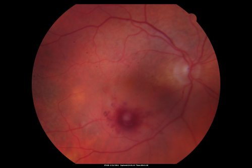 Retinal Arterial Macroaneurysm - Ruptured and self-sealed after hemorrhage
90-year-old woman has vision loss in the right eye for 6 weeks.  OD 8/200,  OS 20/50.  Initial Visit
