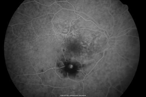 Retinal Arterial Macroaneurysm - Ruptured and self-sealed after hemorrhage
90-year-old woman has vision loss in the right eye for 6 weeks.  OD 8/200,  OS 20/50.  Initial Visit
