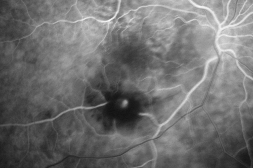 Retinal Arterial Macroaneurysm - Ruptured and self-sealed after hemorrhage
90-year-old woman has vision loss in the right eye for 6 weeks.  OD 8/200,  OS 20/50.  Initial Visit
