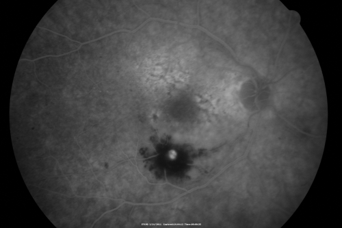 Retinal Arterial Macroaneurysm - Ruptured and self-sealed after hemorrhage
90-year-old woman has vision loss in the right eye for 6 weeks.  OD 8/200,  OS 20/50.  Initial Visit

