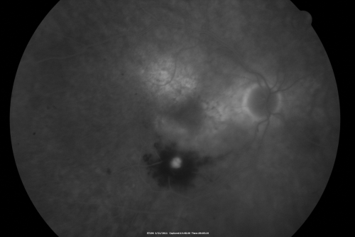Retinal Arterial Macroaneurysm - Ruptured and self-sealed after hemorrhage
90-year-old woman has vision loss in the right eye for 6 weeks.  OD 8/200,  OS 20/50.  Initial Visit
