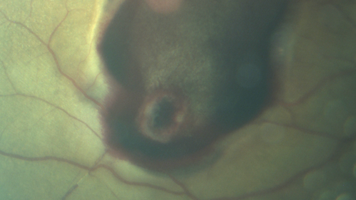 Macroaneurysm - Macular Hemorrhage - Branch Retinal Aterial Occlusion
62 year old African American female with chronic hypertension and vision loss for 2 weeks.  VA is 20/400
