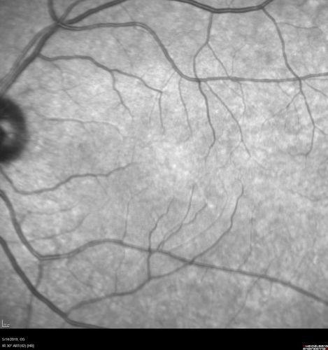 Macroaneurysm - Macular Hemorrhage - Branch Retinal Aterial Occlusion
62 year old African American female with chronic hypertension and vision loss for 2 weeks.  VA is 20/400
