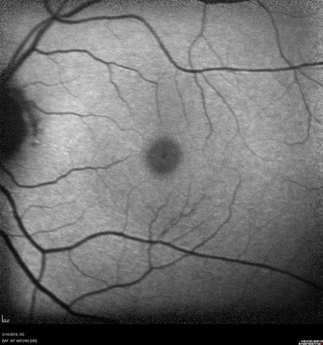 Macroaneurysm - Macular Hemorrhage - Branch Retinal Aterial Occlusion
62 year old African American female with chronic hypertension and vision loss for 2 weeks.  VA is 20/400
