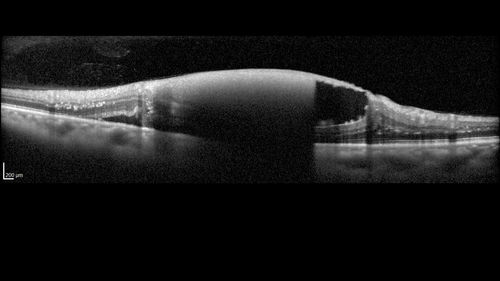 Macroaneurysm - Macular Hemorrhage - Branch Retinal Aterial Occlusion
62 year old African American female with chronic hypertension and vision loss for 2 weeks.  VA is 20/400
