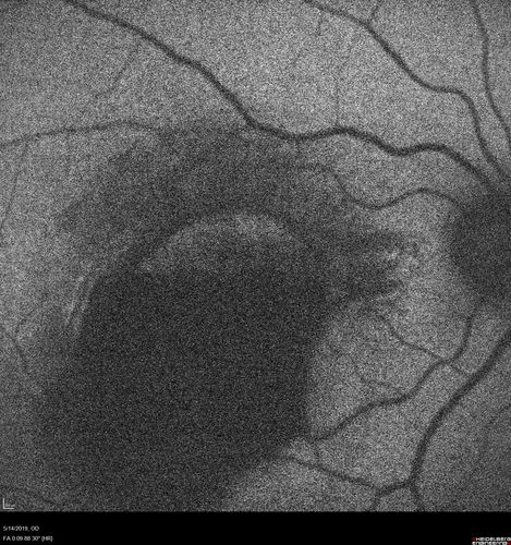 Macroaneurysm - Macular Hemorrhage - Branch Retinal Aterial Occlusion
62 year old African American female with chronic hypertension and vision loss for 2 weeks.  VA is 20/400
