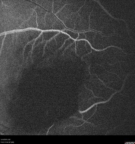 Macroaneurysm - Macular Hemorrhage - Branch Retinal Aterial Occlusion
62 year old African American female with chronic hypertension and vision loss for 2 weeks.  VA is 20/400
