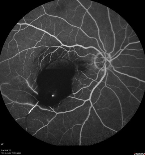 Macroaneurysm - Macular Hemorrhage - Branch Retinal Aterial Occlusion
62 year old African American female with chronic hypertension and vision loss for 2 weeks.  VA is 20/400
