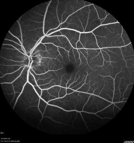 Macroaneurysm - Macular Hemorrhage - Branch Retinal Aterial Occlusion
62 year old African American female with chronic hypertension and vision loss for 2 weeks.  VA is 20/400
