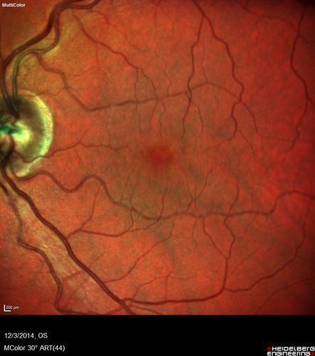 Macroaneurysm - Resolved without treatment
87 year old female with vision loss OD.  Initial FA showed no leakage so no treatment was done and the fluid absorbed over 4 months.  Initial VA 20/100, Final VA 20/80
