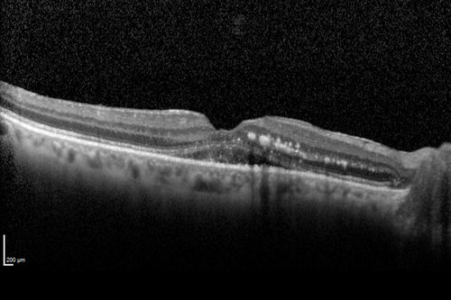 Macroaneurysm - Resolved without treatment
87 year old female with vision loss OD.  Initial FA showed no leakage so no treatment was done and the fluid absorbed over 4 months.  Initial VA 20/100, Final VA 20/80
