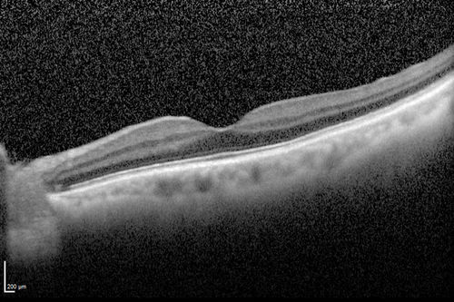 Macroaneurysm - Resolved without treatment
87 year old female with vision loss OD.  Initial FA showed no leakage so no treatment was done and the fluid absorbed over 4 months.  Initial VA 20/100, Final VA 20/80
